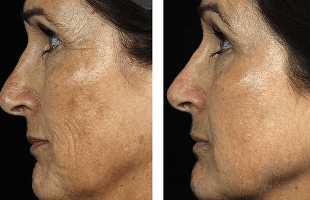 Antes e depois do rejuvenescimento facial fracionado