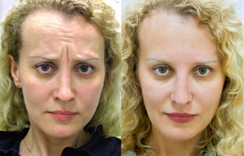 antes e depois de usar o massageador para rejuvenescimento ltza foto 1