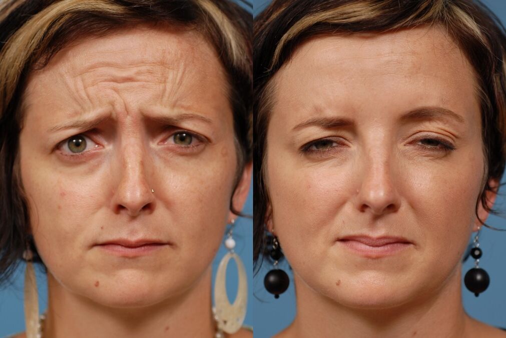 antes e depois de usar o massageador para rejuvenescimento ltza foto 2