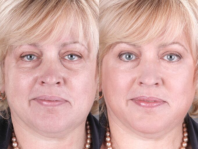antes e depois de usar o massageador para rejuvenescimento ltza foto 3