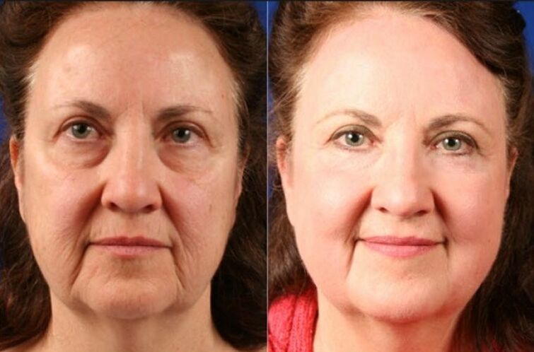 antes e depois de usar o massageador para rejuvenescimento ltza foto 6