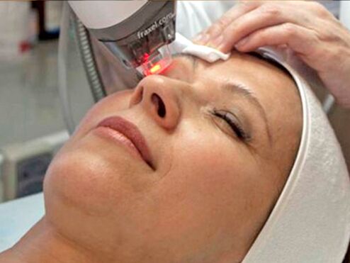 rejuvenescimento a laser da pele ao redor dos olhos
