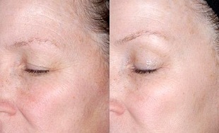 rejuvenescimento da pele ao redor dos olhos antes e depois das fotos