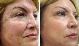 rejuvenescimento fracionário da pele antes e depois das fotos