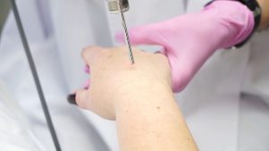 Rejuvenescimento a laser da pele das mãos