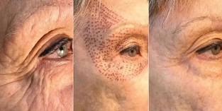 fotos antes e depois do rejuvenescimento da pele por plasma